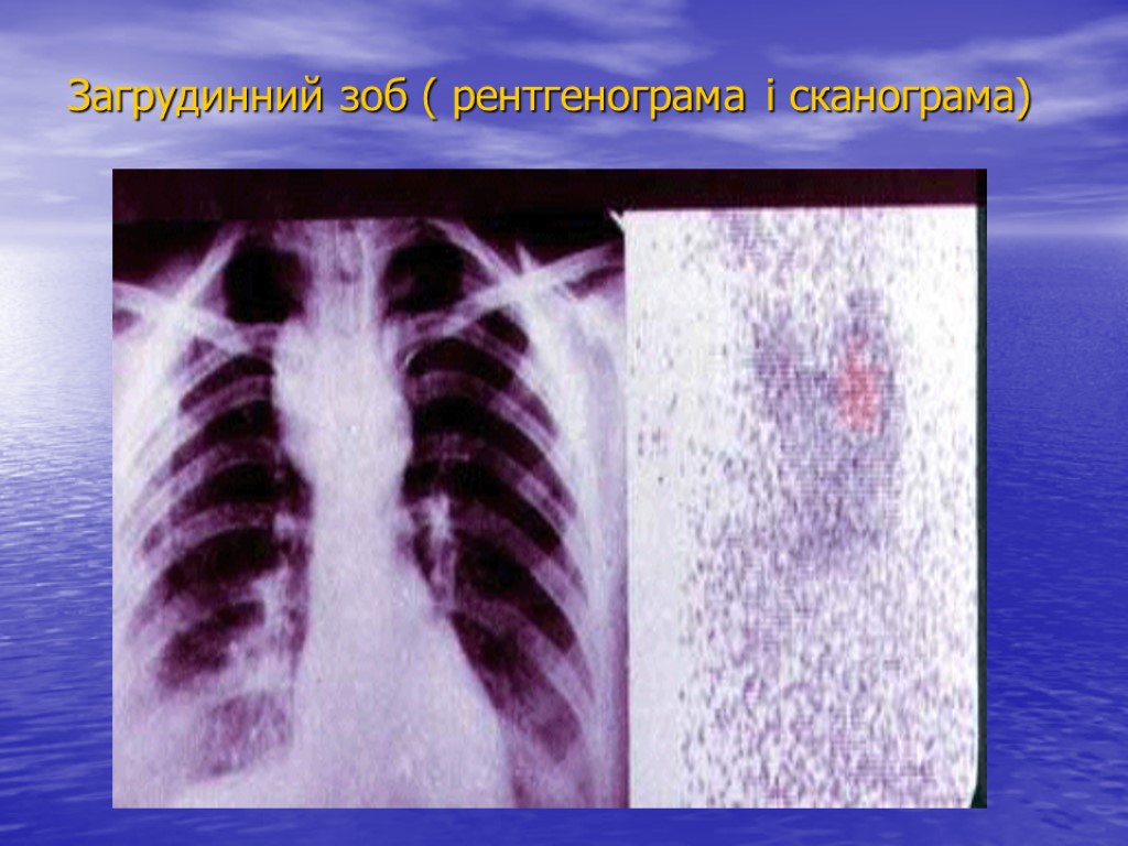 Загрудинний зоб ( рентгенограма і сканограма)